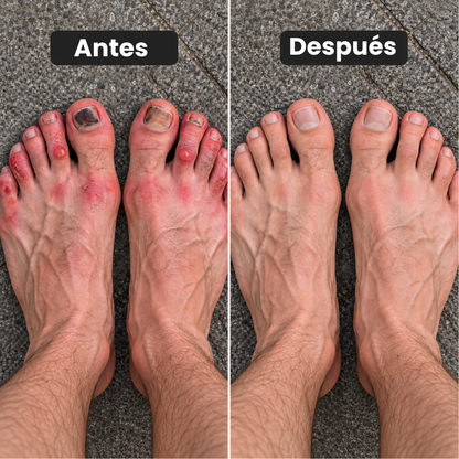 RunGuard™ Protectores para Dedos